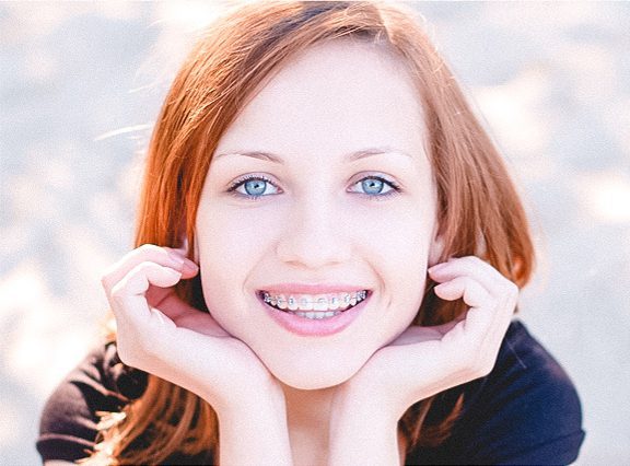 Woman smiling and wearing clear metal braces