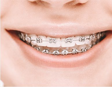 Woman smiling showing silver braces on her teeth